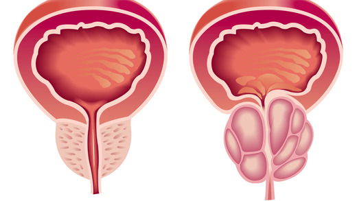 Zvětšená prostata